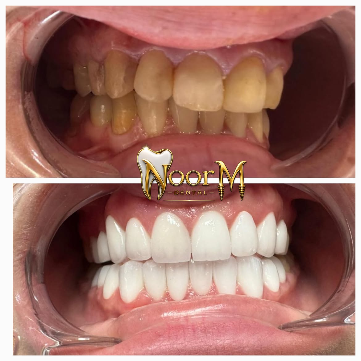 Shade Restoration & Crown Fitting